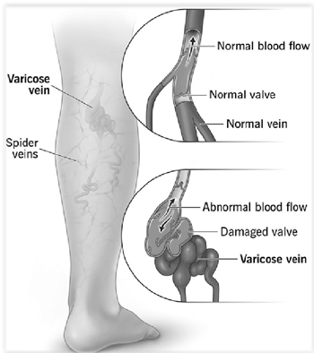 நரம்புச்சுருள் நோய் (Vericose Vein)