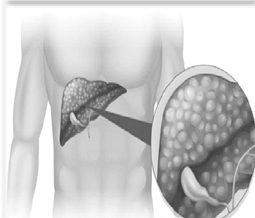 கல்லீரலில் கொழுப்பு சேர்வதை தடுக்க